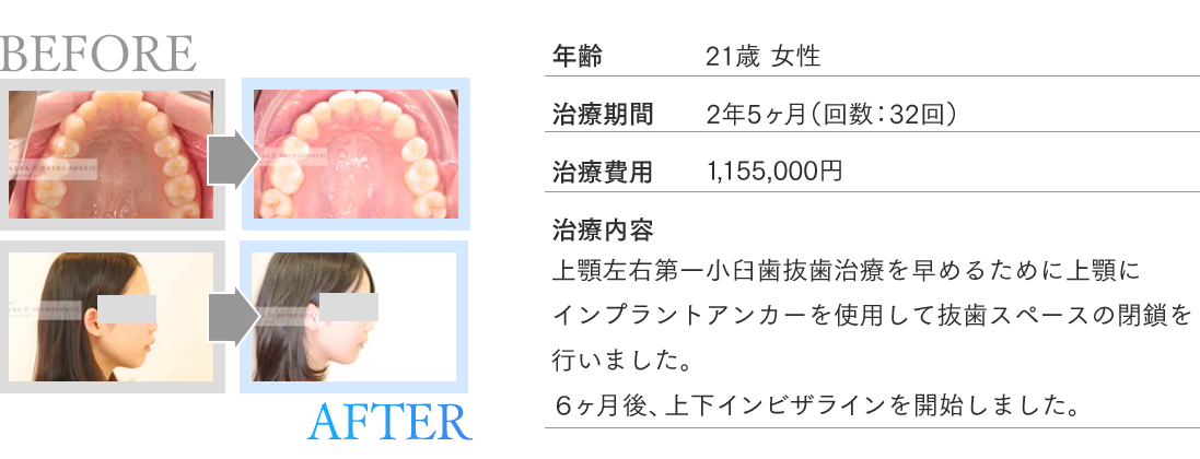 年齢21歳 女性 治療期間 2年5ヶ月（回数：32回） 治療費用 1,155,000円 治療内容 上顎左右第一小臼歯抜歯治療を早めるために上顎にインプラントアンカーを使用して抜歯スペースの閉鎖を行いました。６ヶ月後、上下インビザラインを開始しました。