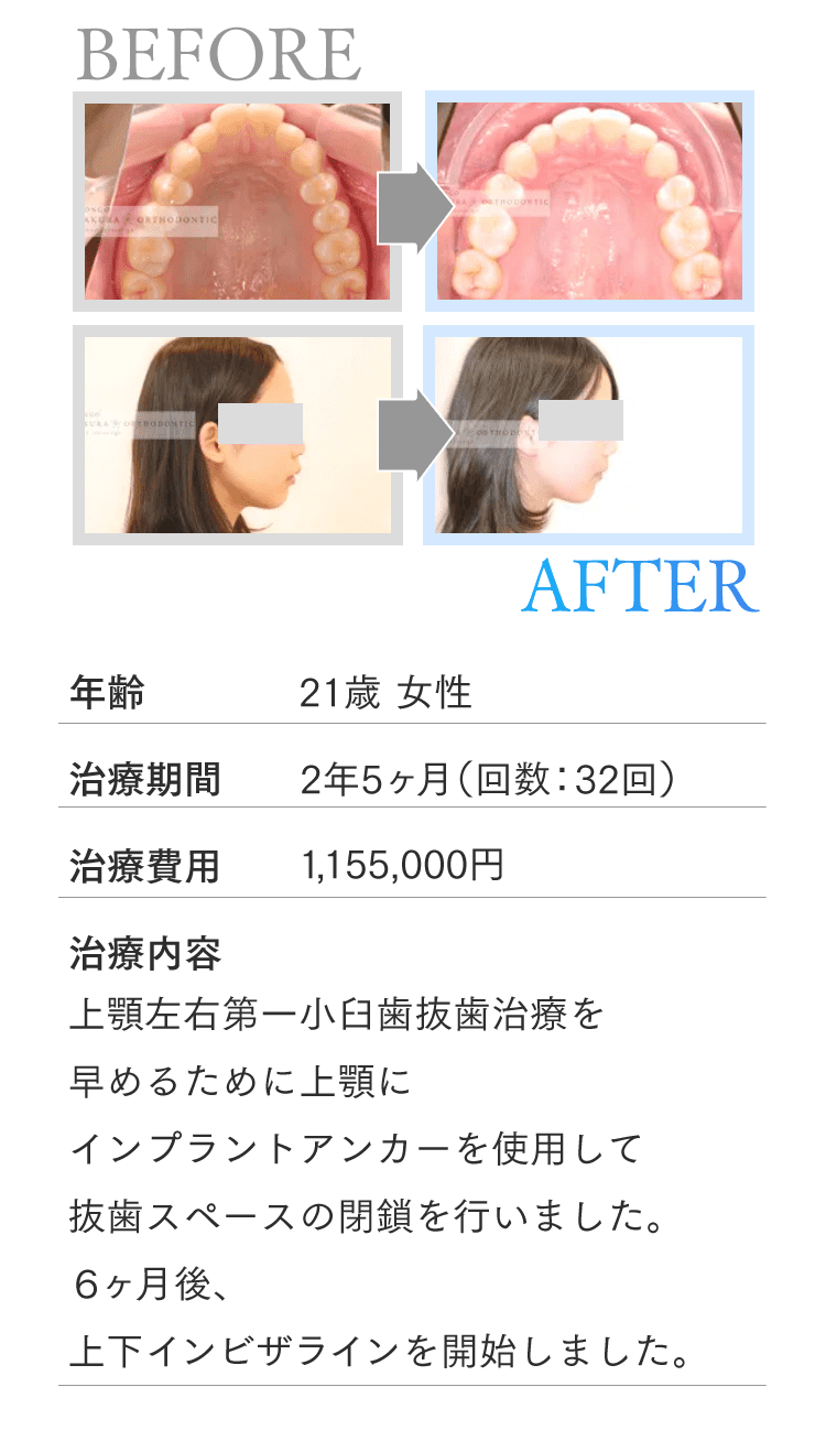 年齢21歳 女性 治療期間 2年5ヶ月（回数：32回） 治療費用 1,155,000円 治療内容 上顎左右第一小臼歯抜歯治療を早めるために上顎にインプラントアンカーを使用して抜歯スペースの閉鎖を行いました。６ヶ月後、上下インビザラインを開始しました。