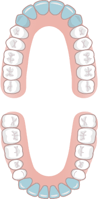 前歯治療（上前歯のみ）